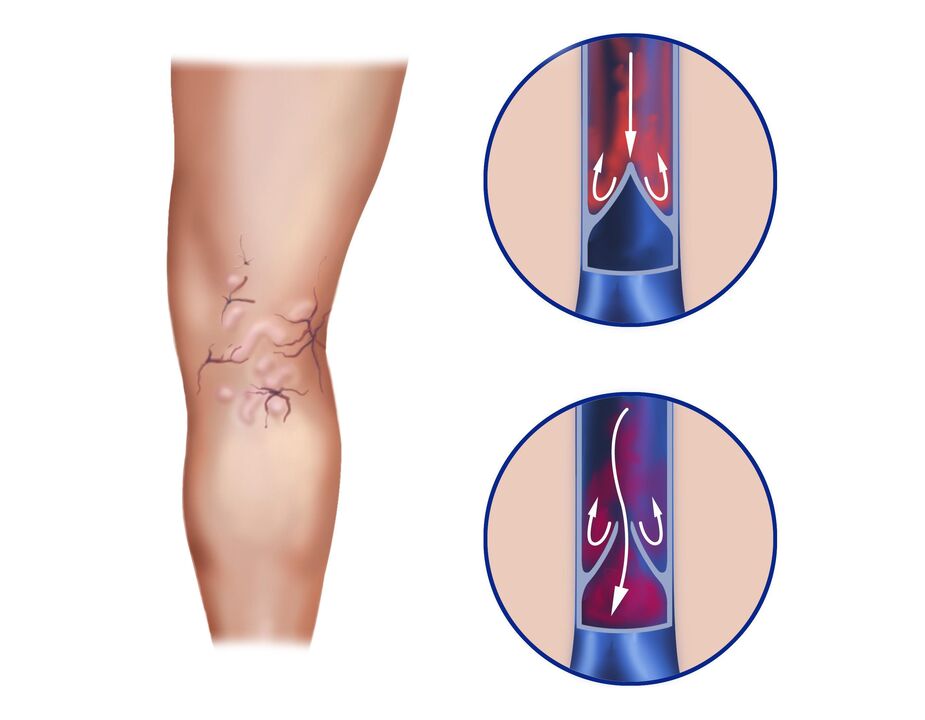 varices